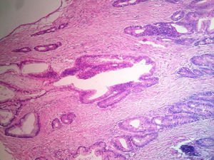 Cistoadenocarcinoma mucinoso bien diferenciado de tipo endocervical e intestinal originado de teratoma quístico maduro de ovario derecho.