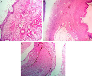 Teratoma quístico maduro en ovario izquierdo (A: epitelio escamoso y estructuras pilosebáceas, B: tejido adiposo maduro y epitelio escamoso, C: tejido glial y coroide maduro).