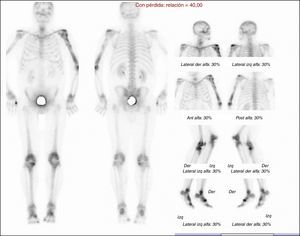 Gammagrafía ósea con Tc-99: importante captación en húmero proximal y diafisiaria izquierda y tibias proximales.