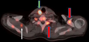 Corte axial que evidencia compromiso metastásico hipermetabólico en el lóbulo derecho de la glándula tiroides (flecha verde), adicionalmente múltiples focos esqueléticos (se señalan algunos con flechas rojas) así como foco muscular (flecha blanca).