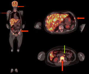 Imágenes en coronal y axial que evidencian gran carga metastásica hipermetabólica en el hígado, se señalan algunas lesiones óseas (flechas rojas) y también adenopatía metastásica retroperitoneal (flecha verde).