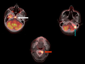 Cortes en axial mostrando compromiso metastásico en base de cráneo (flechas blanca y verde) así como cervical (flecha roja).