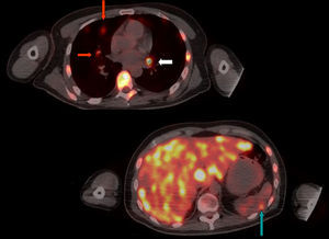 Múltiples focos metastásicos a nivel pulmonar (flechas rojas), hilio izquierdo (flecha blanca), hígado, bazo (flecha verde).