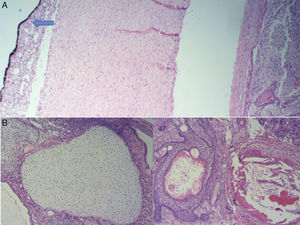 Coloración hematoxilina eosina: A. Con aumento de 4X se observa un tumor germinal que ocupa cámara posterior con invasión del coroides (flecha). B. Con aumento de 10X se observa una mezcla de elementos maduros que incluyen cartílago, piel, glándulas mucinosas y estroma.