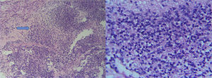Coloración de hematoxilina eosina: con aumento 10X y 40X se observa la presencia de tejido neural con múltiples focos inmaduros tipo neuropilo con pseudorosetas (flecha).