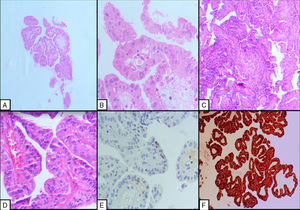 Carcinoma papilar de tiroides con metástasis pancreáticas: formaciones sueltas papilares H&E 4X (A) revestidas por células foliculares con inclusiones intranucleares H&E 20X (B) y presencia en el tejido tiroideo de papilas H&E 10x (C) y células tumorales con inclusiones y hendiduras nucleares H&E 20X (D). Se observa inmunohistoquímica negativa 40X para calretinina (E) y positividad para Galectina-3 10X (F).