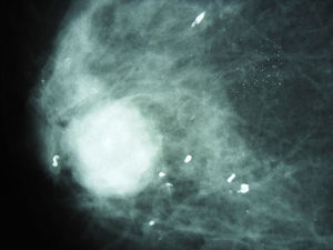 Mamografía que muestra lesión tumoral con macrocalcificaciones periféricas.