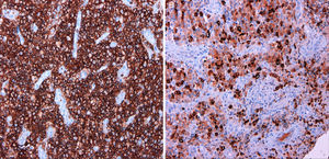 A-B (H-E, 40x). El estudio inmunohistoquímico muestra una intensa positividad difusa de las células para CD43 (imagen izquierda), que también es positiva para mieloperoxidasa (imagen derecha).