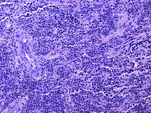 (H-E, 40x). Tejido fibroso periostal con denso infiltrado celular polimorfo, donde se reconocen linfocitos con aislados eosinófilos y células de mayor tamaño, de aspecto inmaduro y de aspecto blástico.