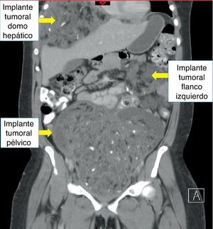 Tomografía axial computarizada de abdomen y pelvis en una paciente femenina de 24 años con diagnóstico de teratoma inmaduro. Corte coronal.