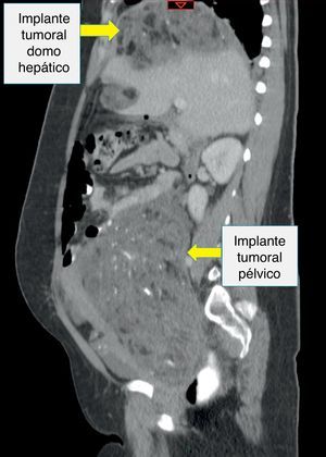 Tomografía axial computarizada de abdomen y pelvis en una paciente femenina de 24 años con diagnóstico de teratoma inmaduro. Corte sagital.