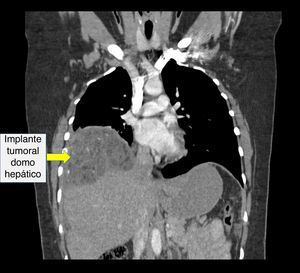 Tomografía axial computarizada de tórax en una paciente femenina de 24 años con diagnóstico de teratoma inmaduro. Corte coronal.