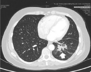 TC con masa parahiliar en pulmón izquierdo como origen primario.