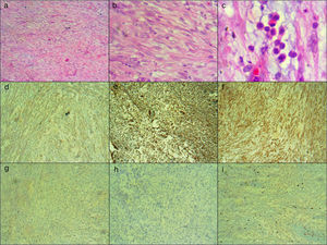 Tumor conformado por células fusiformes dispuestas en fascículos laxos sobre estroma mixoide, severo infiltrado inflamatorio constituido por mastocitos, histiocitos, linfocitos, plasmocitos y polimorfonucleares neutrófilos y eosinófilos, con congestión vascular y focal, extravasación de glóbulos rojos con ocasionales mitosis (a),(b),(c). Inmunohistoquímica positiva para actina de músculo liso (d); vimentina (e); y caldesmon (f); inmunohistoquímica negativa para desmina (g) y ALK (h). También se evidencia negatividad para calretinina, inhibina, S100, receptores de progesterona, CD99, citoqueratina coctel (AE1/AE3), citoqueratina 7, e-cadherina, citoqueratina 20, P63, CD117, CD34 y DOG 1; índice de proliferación (Ki67) del 5% (i).