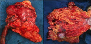 Pieza quirúrgica: útero y anexo derecho (izquierda); epiplón con lesiones tumorales macroscópicas (derecha).