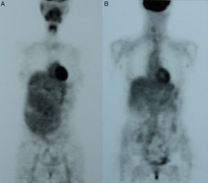 A y B. PET al dignóstico (A) y tras cuatro meses de tratamiento con imatinib (B).