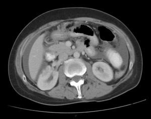 Tomografía abdominal contrastada. Muestra líquido libre en la cavidad peritoneal.