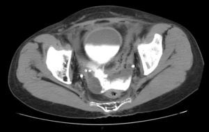 Tomografía abdominal contrastada. Muestra filtración del contraste de la vejiga a la cavidad peritoneal.