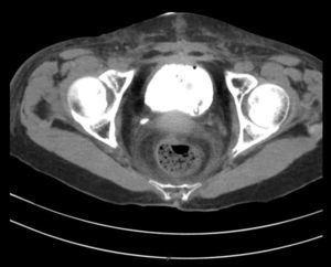 Tomografía abdominal contrastada de control. Muestra integridad de la vejiga sin extravasación del medio de contraste posterior a sutura de la vejiga.