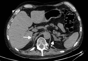 Paciente con tumor neuroendocrino pulmonar (carcinoide típico) con metástasis hepáticas y síndrome de Cushing. Se aprecia hiperplasia suprarrenal bilateral (flechas).