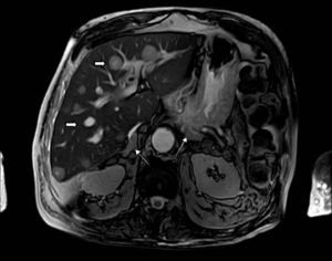 Síndrome de Cushing ectópico por carcinoma neuroendocrino pancreático. Resonancia abdominal de un paciente con carcinoma neuroendocrino (Ki67 40%) de origen pancreático con metástasis hepáticas (flecha gruesa) y síndrome de Cushing con hiperplasia suprarrenal bilateral (flecha delgada).