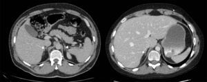 Adrenales normales. Para comparación se presenta la tomografía de un paciente de 18 años donde se aprecian las glándulas suprarrenales de tamaño normal. Compárese el tamaño con las figuras 1 y 2