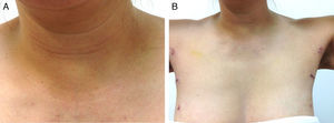 A. Estado 6 día postoperatorio: tiroidectomía total endoscopia aspecto del cuello. B. Estado 6 día postoperatorio: tiroidectomía total endoscópica aspecto del área axilar bilateral.