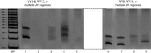 Evaluación de reordenamientos de las cadenas gamma del receptor de antígeno de las células T por medio de PCR. Análisis de heterodupletas por medio de electroforesis en gel de poliacrilamida al 6%. Pozos 1-5 regiones variables 1-8 y 10. MP: Marcador de Peso 100 pb. 1: Control Positivo. Rango esperado: 145-255 pb. 2: Control Negativo Mix PCR+Agua. 3: Caso 1 4: Caso 2. 5: Caso 3. Pozos 6-9, regiones variables 9,11 y otras. 6: Control Positivo. Rango esperado: 80-220 pb. 7: Caso 2. 8: Caso 2. 9: Caso 3.