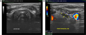 Ecografía prequirúrgica: A. Lecho tiroideo sin evidencia de lesiones sospechosas. B. Lesión paratraqueal izquierda del nivel VI.