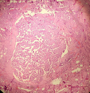 Microtumor papilar. Se observa un carcinoma papilar de patrón clásico de menos de 1cm de diámetro sin extensión extratiroidea (H&E 10x).