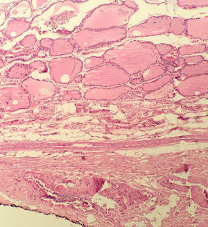 Ausencia de cápsula tiroidea. Transición abrupta del tejido tiroideo normal al tejido adiposo extratiroidea (H&E 10x).