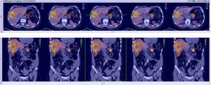 Fusión HYNIC-TOC (gammagrafía octreotide-tecnecio)+IRM de abdomen: muestra los sitios de sobreexpresión de receptores de somatostatina.
