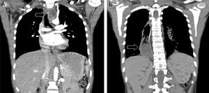 A: TAC del tórax al diagnóstico. La flecha indica la lesión ulcerada con realce del medio de contraste en la pared derecha del tercio medio del esófago cercana a la bifurcación de la carina con estriación leve de la grasa del mediastino posterior adyacente. B. TAC del tórax posterior a neoadyuvancia y control local. Se observan cambios postquirúrgicos de esofagectomía; la flecha muestra el ascenso gástrico.