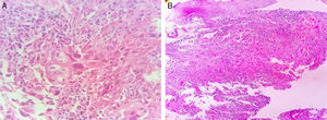 Imagen de Carcinoma adenoescamoso invasor del esófago donde se observan: A. áreas de adenocarcinoma y B. áreas de carcinoma escamoso.