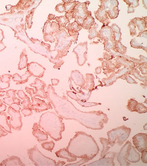 HMBE-1. Positividad en las células tumorales de un carcinoma papilar de tiroides. (10x).