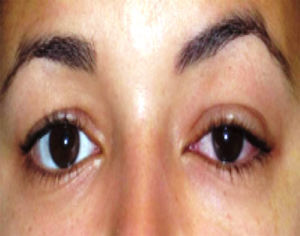 Fotografía clínica de la paciente donde se observa el aumento de volumen supero externo en ojo derecho con aumento de la inyección conjuntival.