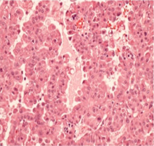 Carcinoma de células acinares de bajo grado CK7(+), CK 14(–), proteína S-100(–), p66(–),CD-117 (c-kit)(–).