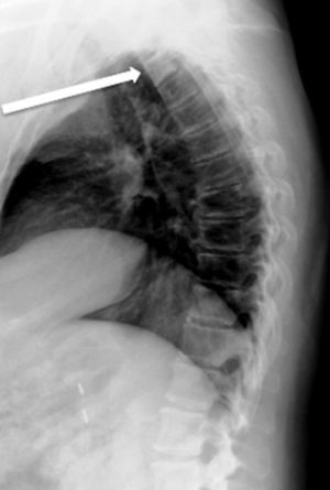 Radiografía lateral de columna dorsal en donde se observa lesión de aspecto osteoblástico en cuerpo vertebral de T3 (Flecha).