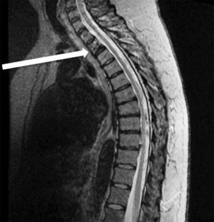RMN. Lesión de comportamiento mixto, predominantemente blástica, con afinidad posterior al contraste paramagnético, con afección de los elementos del arco posterior, a nivel de cuerpo vertebral de T3 (Flecha).