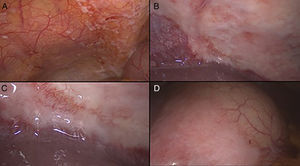 A, B y C Carcinomatosis peritoneal. D Compromiso tumoral de la serosa T4a.