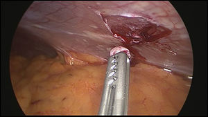 Biopsia de siembras peritoneales por laparoscopia.