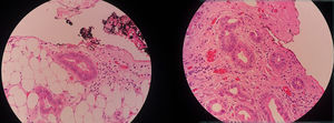 Peritoneo parietal infiltrado por focos de adenocarcinoma. Hematoxilina y eosina.