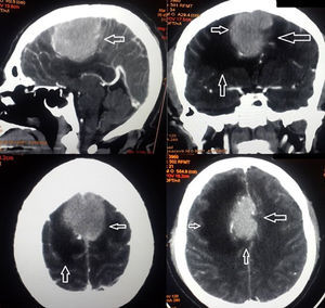 Tomografía cerebral con imagen hiperdensa en la cisura medial, con características de meningioma dependiente de la hoz del cerebro con importante edema pericisural y borramiento del espacio subaracnoideo.