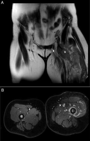 (A) Angio RMN (corte coronal). Compresión extrínseca de vena femoral (flecha) por tumoración (asterisco). Importante reacción de partes blandas. (B) Angio RMN (corte longitudinal) Extremidad inferior izquierda. Trombosis focal de vena femoral izquierda (flecha).