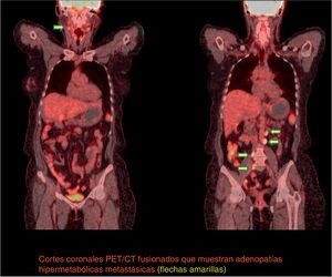 Primer PET/CT Axial. Cortes coronales PET/CT fusionados que muestran adenopatías hipermetabólicas metastásicas (flechas amarillas).