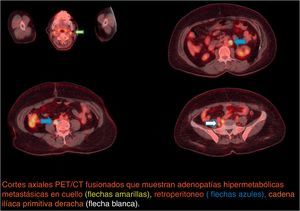 Primer PET/CT Coronal. Cortes axiales PET/CT fusionados que muestran adenopatías hipermetabólicas metastásicas en cuello (flechas amarillas), retroperitoneo (flechas azules), cadena ilíaca primitiva derecha (flecha blanca).