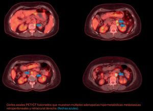 Segundo PET/CT Axial. Cortes axiales PET/CT fusionados que muestran múltiples adenopatías hipermetabólicas metastásicas retroperitoneales y retrocrural derecha (flechas azules).