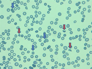 Frotis de sangre periférica, con presencia de esquistocitos o células “casco” (flecha roja), microesferocitos (flechas azules), hallazgos sugestivos de hemolisis microvascular.