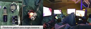 Imágenes de la plataforma de cirugía transanal. Equipo quirúrgico realizando la exéresis quirúrgica por TAMIS (Transanal Minimal Surgery).