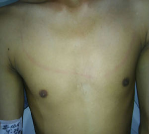 Fotografía del torso del paciente con evidencia de raya meningítica de Trousseau.